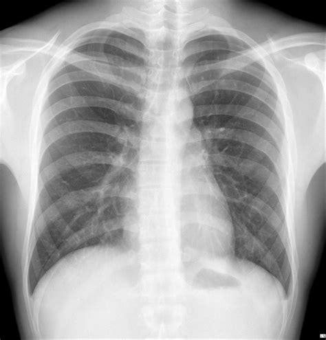 Chest X Ray Interpretation In Patients Cough A Week Radiology Imaging