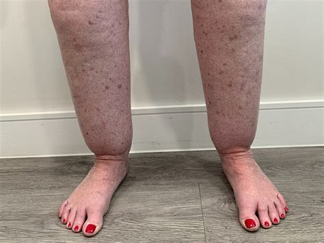 Lipedema Guide Causes Symptoms Treatments And More Tactile Medical