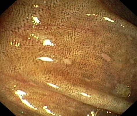 Melanosis Coli Benign Pigmentation Of The Colon Most Frequently