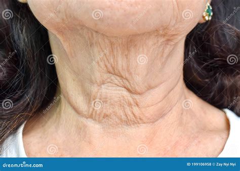 Aging Skin Folds Or Skin Creases Or Wrinkles At Neck Of Asian Chinese