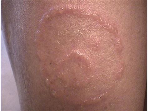 Tinea Fungal Infections Pictures Photos