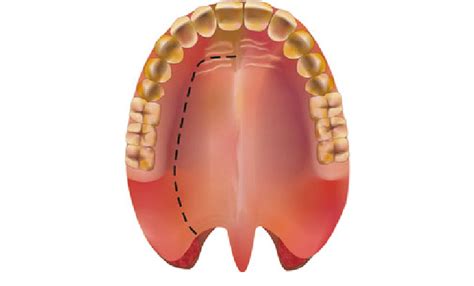 Schematic Diagram Of The Incision For The Lateral Palatal Flap