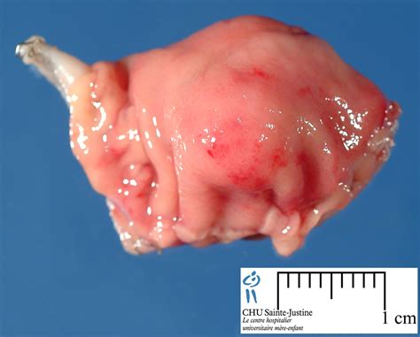 Read below for more fun and interesting facts about. digestive pancreatic heterotopia - Humpath.com - Human ...
