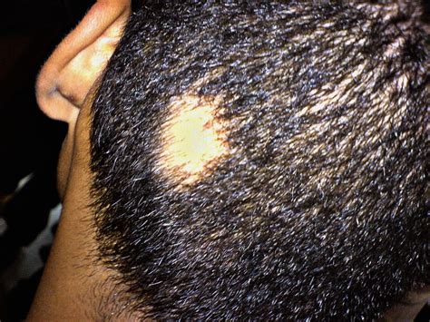 I went to see my doctor and had some blood taken for a test, but the results have come there is no irritation of the patches so my doctor will not refer me to a dermatologist but i'm still losing my hair. Symptoms Of Stress That You Should Know Before Its Too Late