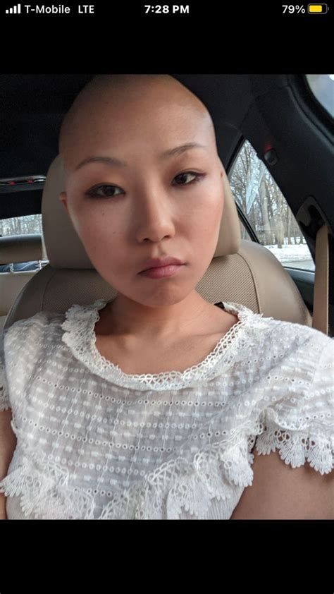 Bald Asian In Bald Hair Balding Baby Face