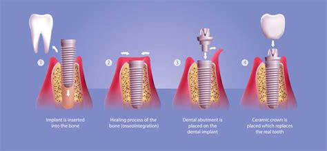 Dental Implants Side Effects  Tarzana Dentist  Victory Cosmetic Dentistry