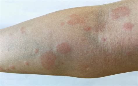 Lupus The Disease That Can Present Just With Joint Pains Initially 2018