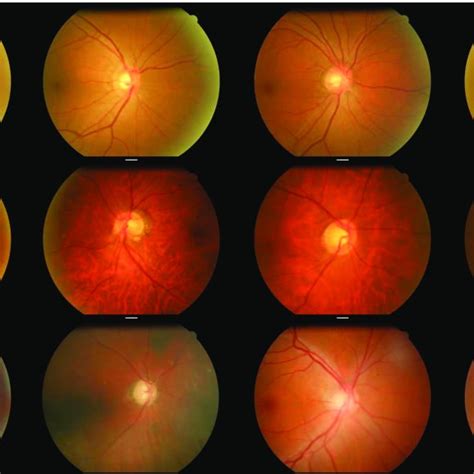 Pdf Automated Tessellated Fundus Detection In Color Fundus Images