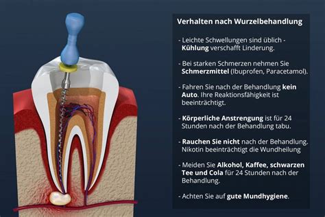 Ruddy Schreiben Blume Wurzelbehandlung Mit Laser Kosten Verbindung