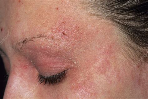 Eczema On A Girls Face Stock Image M1500237 Science Photo Library
