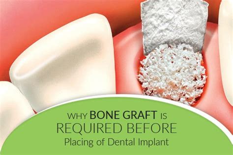 Why Bone Graft Is Required Before Placing Of Dental Implant
