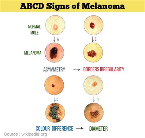 Abcde Melanoma