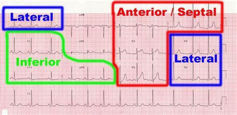 Heart Walls On Ekg Clinical Ecg Ekg Interpretation