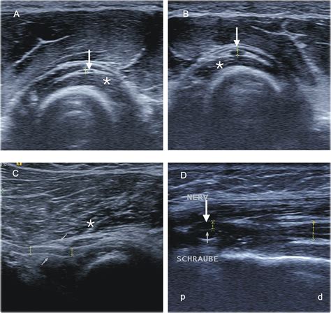 Sonographic Studies Of A Patient With A Proximal Radial Nerve