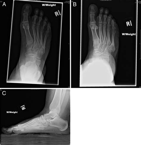 Treatment Of Jones Fracture Nonunion With Isolated Intramedullary Screw