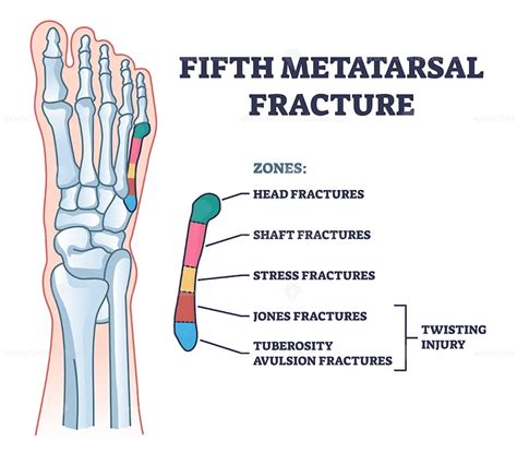 Fifth Metatarsal Or Foot Little Finger Fracture After Injury Outline