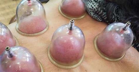 5 Things That Happen To Your Body When You Try Cupping