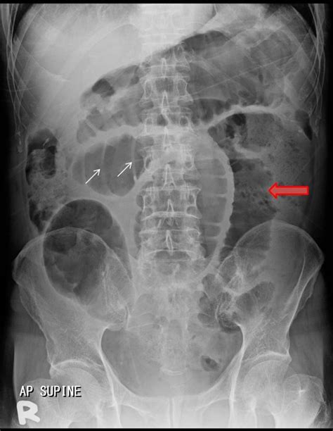 Small Bowel Obstruction Radiology Cases