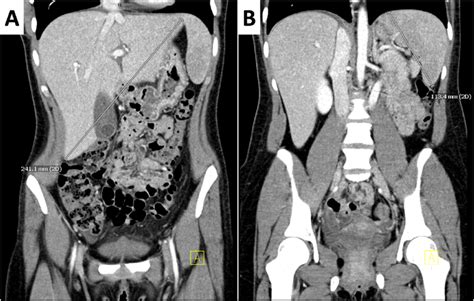 Contrast Enhanced Ct Scan Of The Abdomen And Pelvis A Hepatomegaly