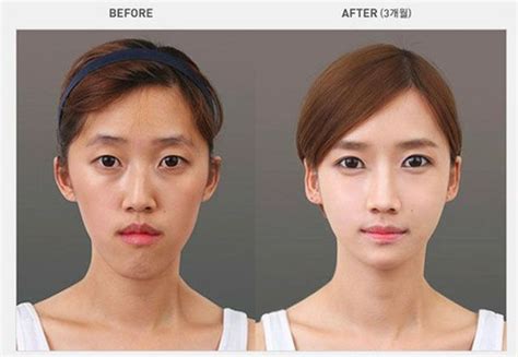 Antes e depois da cirurgia plástica coreana 2 61 fotos MDig