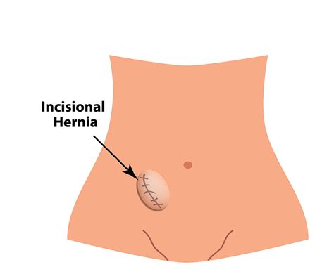 Femoral Hernias Occur Below The Inguinal Femoral Hernias Occur Inguinal