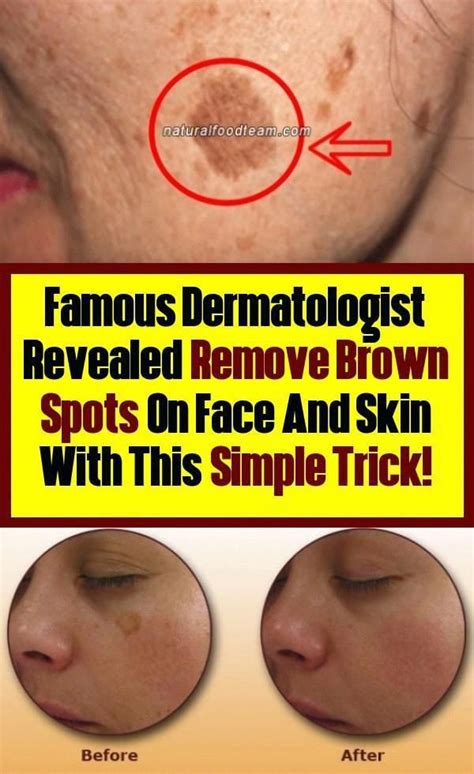 How To Get Rid Of Black Spots On Face Brownspotsonskin Brown Spots