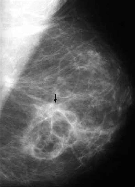 Fat Necrosis Left Mediolateral Mammogram Of A Patient Who Had