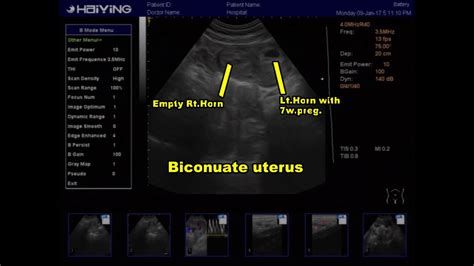 Ultrasound Bicornuate Uterus With W Preg YouTube