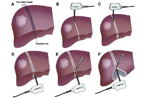 The Aim Of Technology During Liver Resection — A Strategy To Minimize