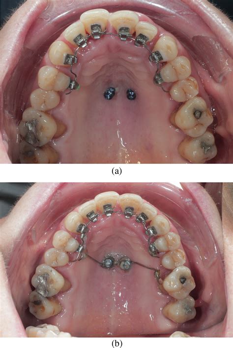 The Use Of Mini Anchorage Screws In The Surgical Orthodontic Treatment