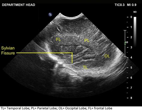 15 Baby Head Ultrasound Anatomy