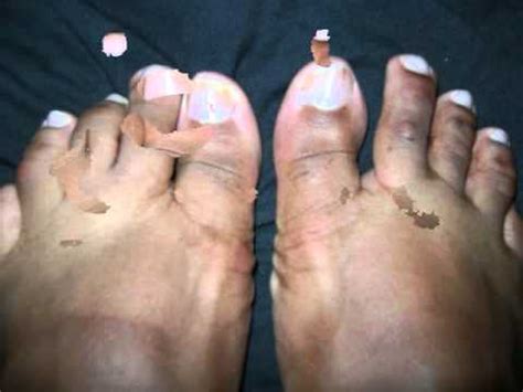 Ketoconazole cream works by inhibiting the growth of a number of types of fungi by preventing production of the membranes that surround fungal cells. Lamisil and Toes Fungus - YouTube