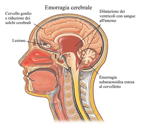 I danni dipendono dalla quantità di sangue che si riversa nella scatola cranica e dall' estensione della zona interessata. Dolore alla nuca destra o sinistra e rimedi