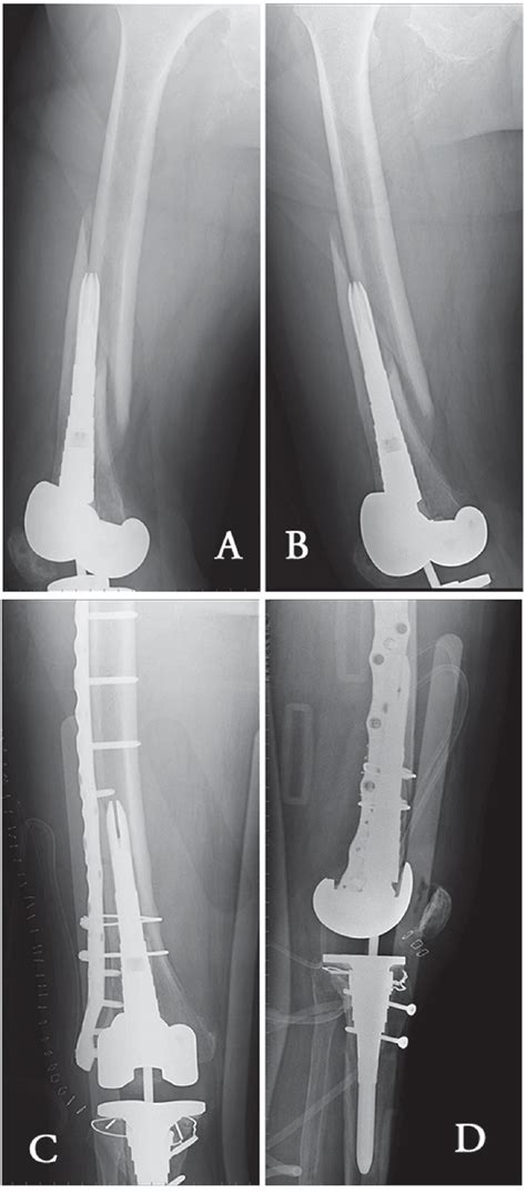 A B Ap And Lateral X Rays Showing A Periprosthetic Distal Femur