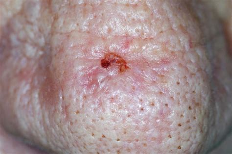 Basal Cell Skin Cancer On The Nose Photograph By Dr P Marazziscience