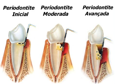Periodontite Revista Brasil Na Mão O Verdadeiro Guia Dos
