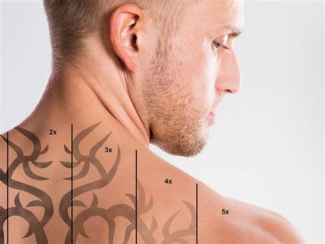 4 Facts About Tattoo Removal Moran Laser And Salon Nashville