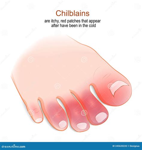Chilblains Humans Foot With Red Or Swollen Toes Stock Vector