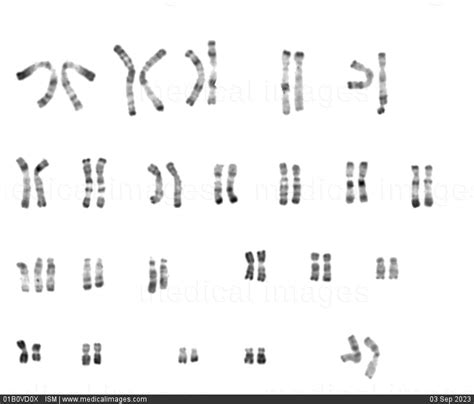 Stock Image Karyotype Of A Female Patient With Trisomy 13 Patau Syndrome R Banding 47 Xx 13