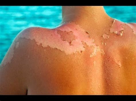We caught up with consultant dermatologist at sloane street's cadogan clinic, dr anjali mahto to get her advice on how to treat sunburn and lose that lobster look for good. sunburn - FirstCare Walk-In Medical Center
