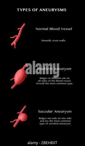 Types Of Aneurysms Stock Photo Alamy