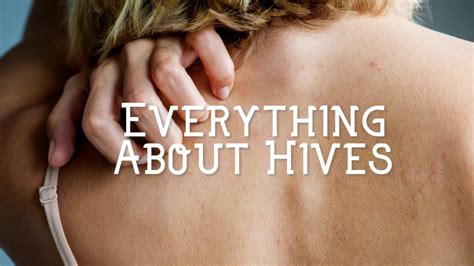 What Causes Hives And How To Treat Them Hubpages