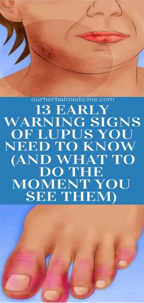 10 Early Warning Signs Of Lupus You Need To Know Wellness Magazine Porn Sex Picture