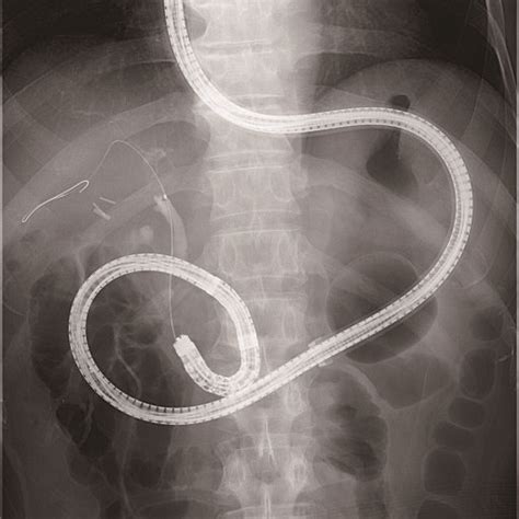 Basics Of Therapeutic Ercp In Patients With Surgically Altered Anatomy