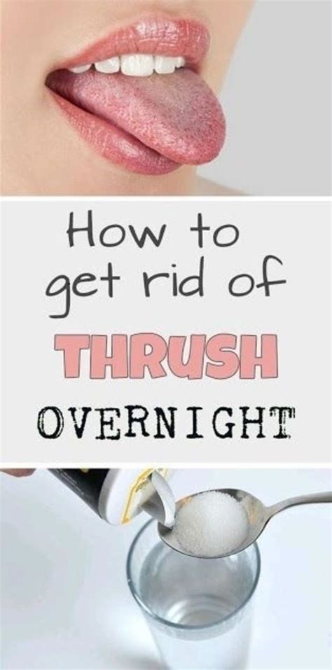 9 Methods For How To Battle Oral Thrush Home Remedies For Thrush Oral Thrush Remedies