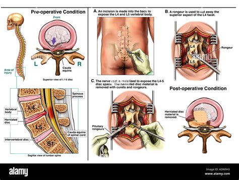 Herniations Hi Res Stock Photography And Images Alamy