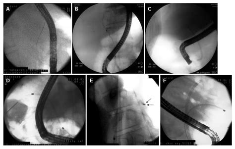 Contrast Free Endoscopic Stent Insertion In Malignant Biliary Obstruction