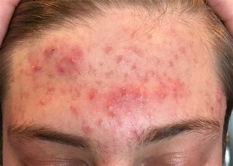 Acne Cystic Acne On Forehead Help
