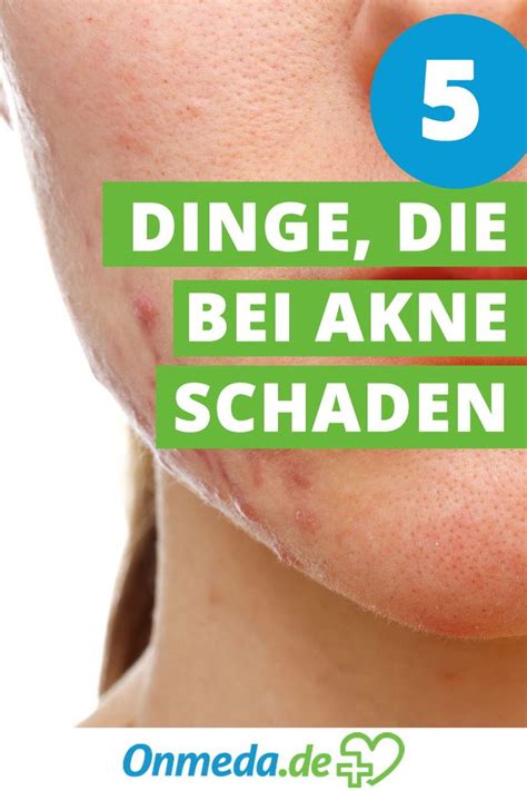 Entdecke rezepte, einrichtungsideen, stilinterpretationen und andere ideen zum ausprobieren. Akne, Akne vulgaris: Behandlung, Medikamente, Ernährung ...