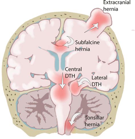 Types Of Cerebral Herniation And Their Imaging Features Radiographics